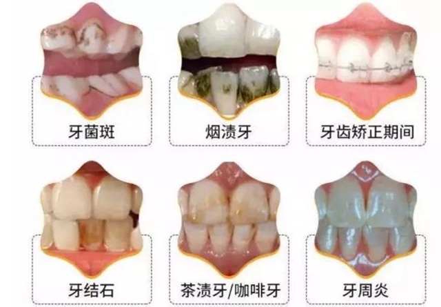 同步爱牙科普日价值500元洗牙礼包免费领!