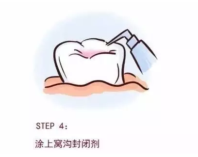 【深圳同步齿科】36.6元超低价抢500元『同步齿科』儿童实用护齿产品三选一套餐：全口涂氟/窝沟封闭1次（1颗）/拔乳牙1次（1颗），深圳40店通用！