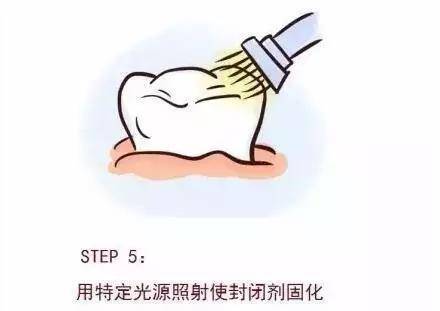 儿童实用护齿产品三选一套餐:全口涂氟/窝沟封闭1次(1颗)/拔乳牙1次(1
