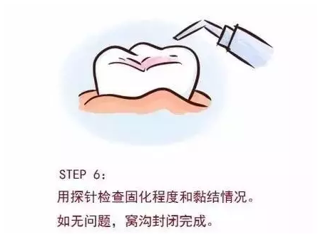 【深圳同步齿科】36.6元超低价抢500元『同步齿科』儿童实用护齿产品三选一套餐：全口涂氟/窝沟封闭1次（1颗）/拔乳牙1次（1颗），深圳40店通用！